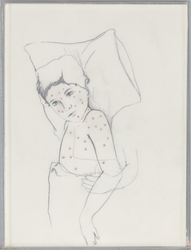 Chicken Pox