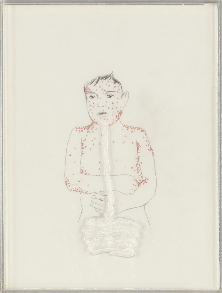 Measles with Intestines
