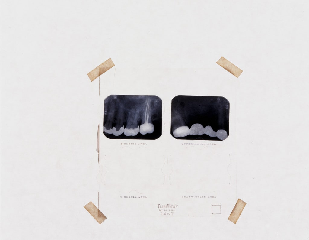 Dental X-Ray