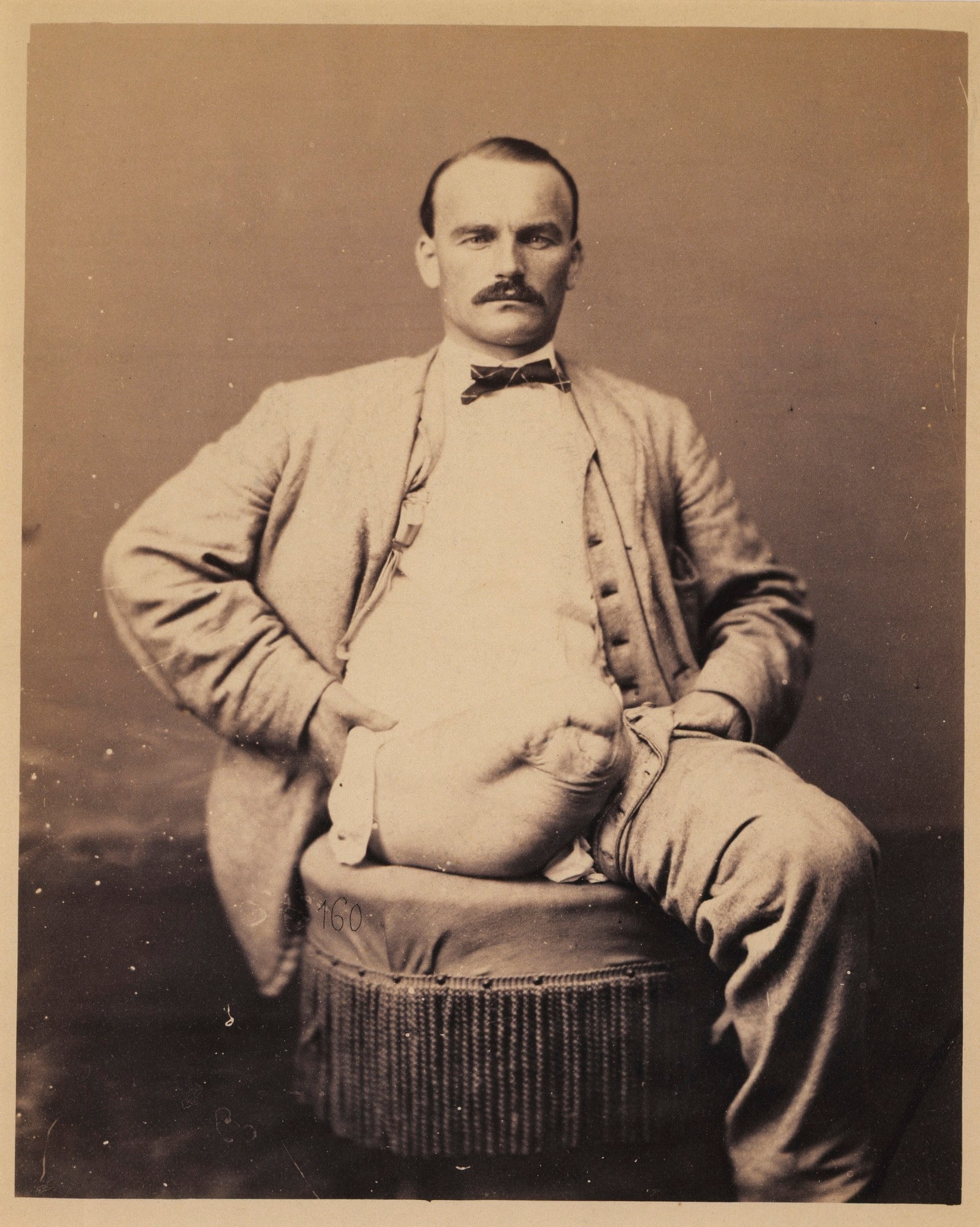 Private Charles Myer, Amputation of the Right Thigh, from the Photographic Catalogue of the Surgical Section