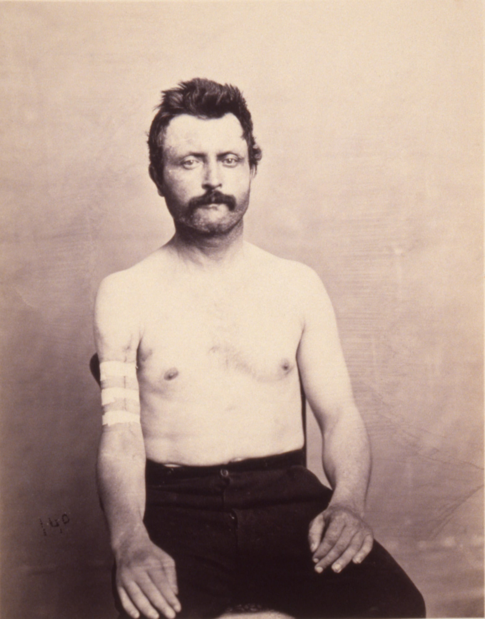 Private John Kelly, Successful Primary Excision of Four inches of the Upper Third of the Shaft of the Right Humerus for Gunshot Fracture, from the Photographic Catalogue of the Surgical Section