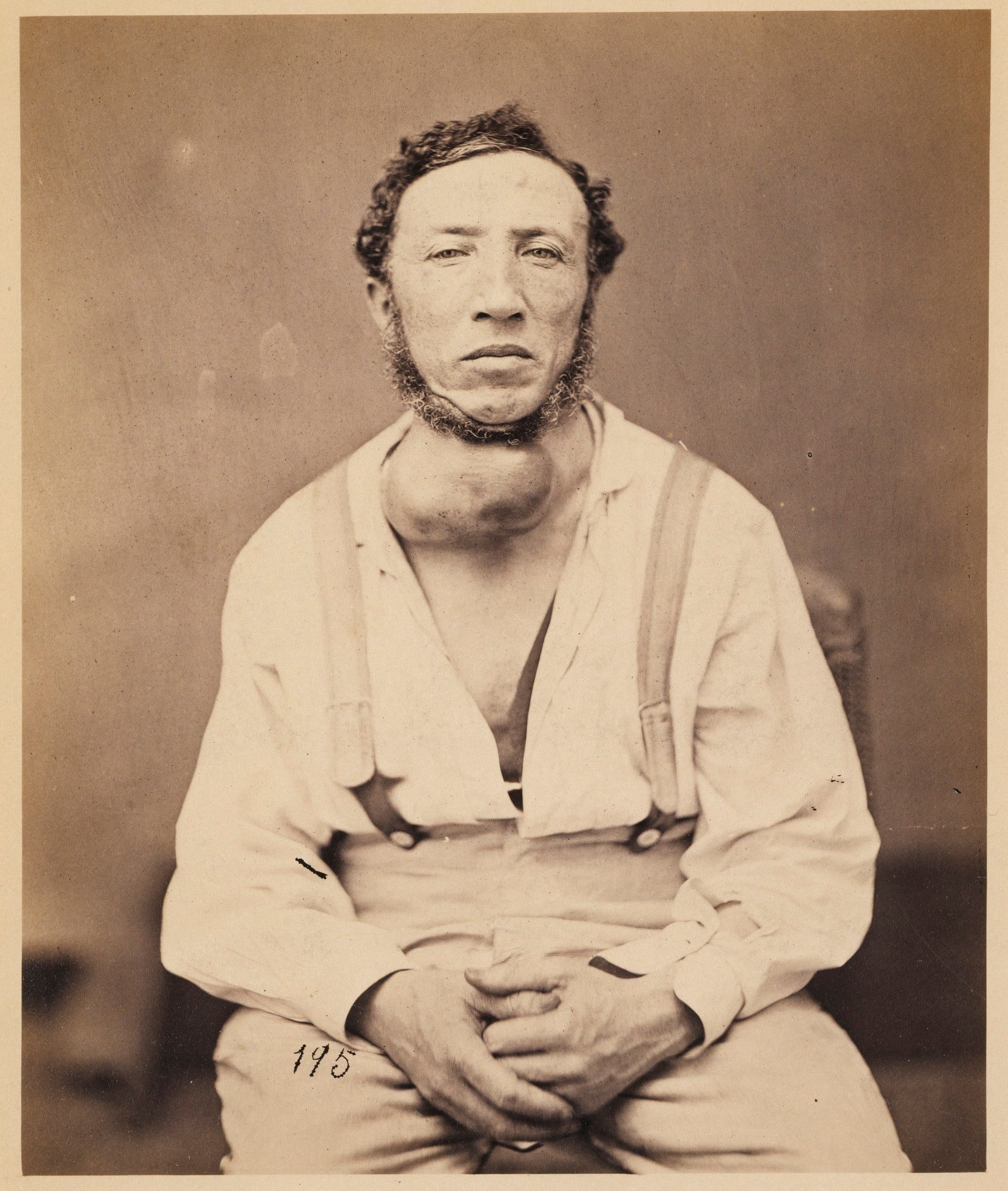 Mr. Joseph Brown, Aneurism of the Innominate Artery, from the Photographic Catalogue of the Surgical Section