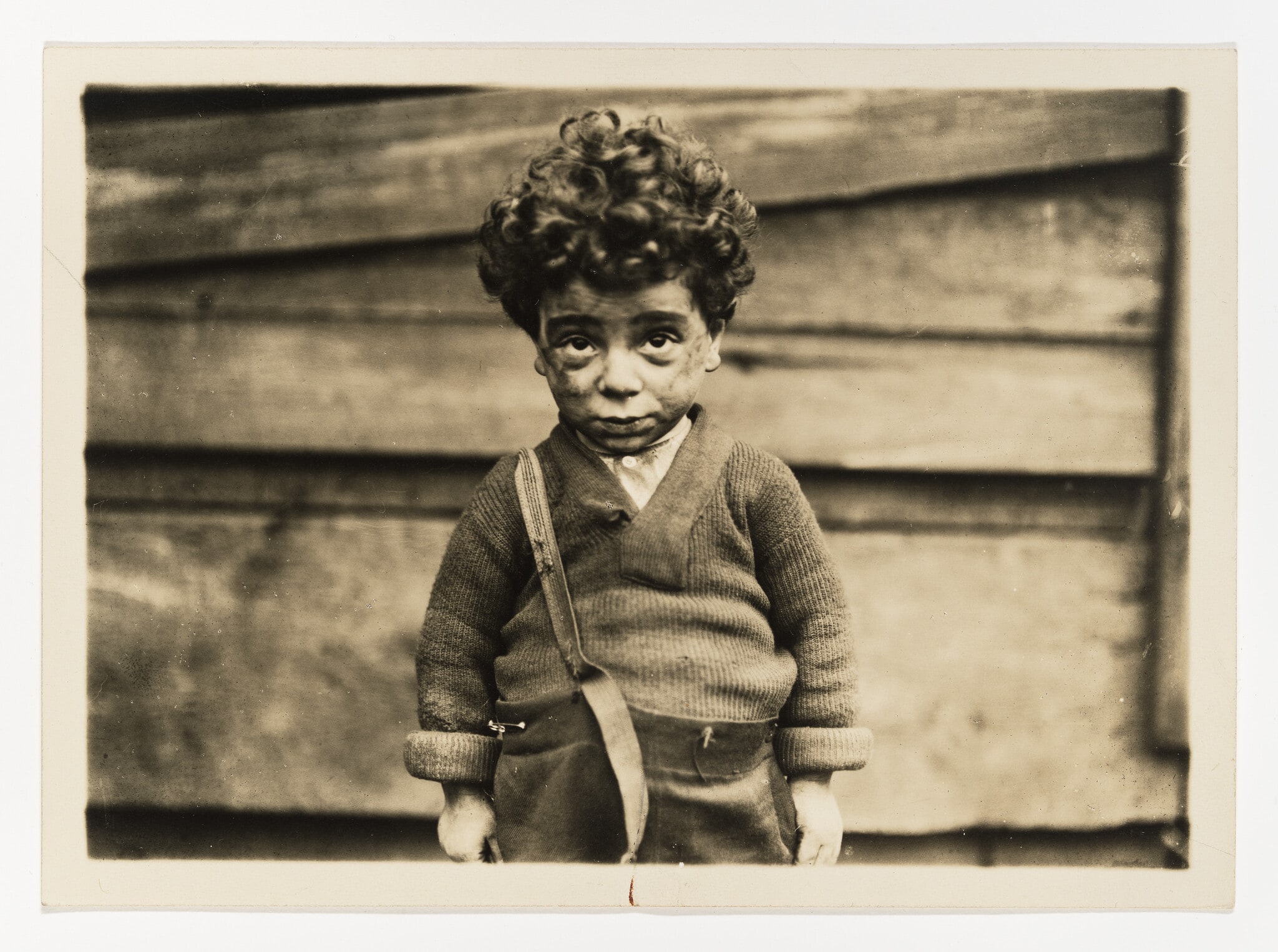 Unhealthy Tenement Child