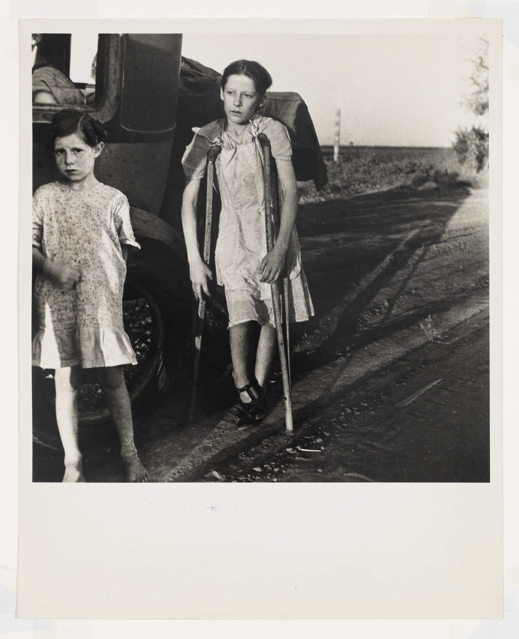 Child of Migrant Family Suffering from Tuberculosis of the Bone, California