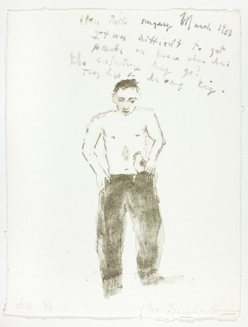 After Bill's Surgery, March 1988/It was difficult to get pants on...where does the colostomy bag go?..., from Bill's Surgery