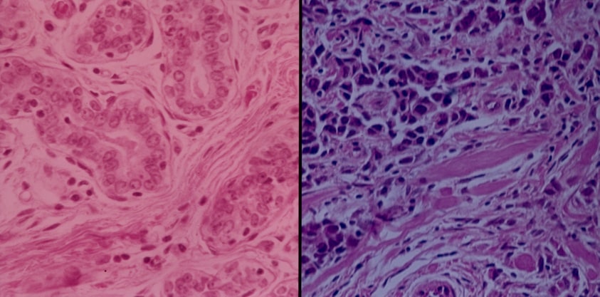 Visualization Image (Breast Cancer)